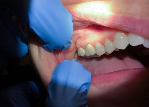 Best Knocked-Out Tooth Emergency  in Lakeland, FL